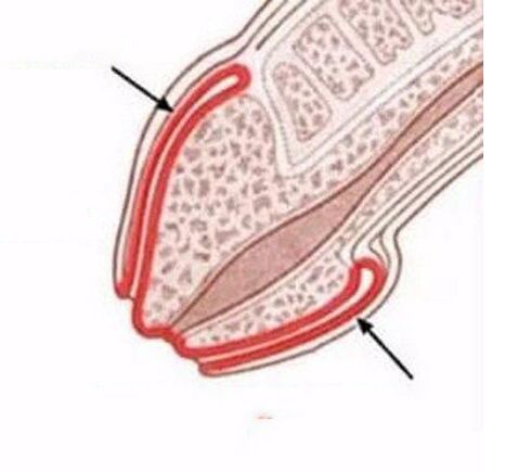Inflammation du pénis