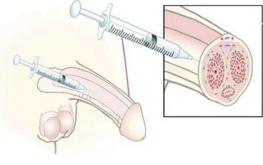 Injection d'acide hyaluronique