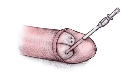 Le gland peut être agrandi en injectant du gel hyaluronique