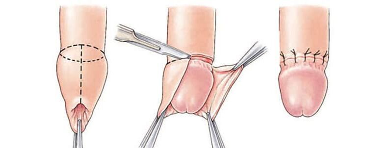 Effet de la circoncision sur la taille du pénis