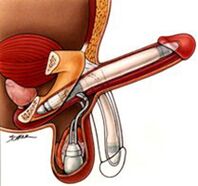 Implants d'agrandissement de pénis pour hommes