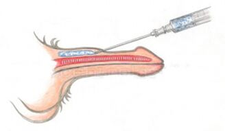 Injection d'acide hyaluronique volumateur dans le pénis